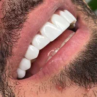 دندانپزشکی کامپوزیت ایمپلنت عصب کشی پر کردن|خدمات آرایشگری و زیبایی|قدس, |دیوار
