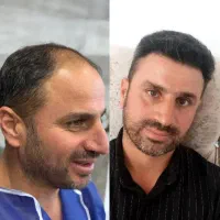 کاشت مو و ابرو