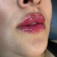 تزریق ژل وبوتاکس هایفو|خدمات آرایشگری و زیبایی|مشهد, کوی سیدی|دیوار