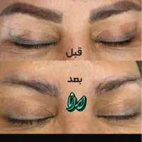 حذف تضمینی تاتوو با دستگاه لیزر(کلینیک ایرانا)