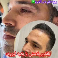 مدل کاشت مو و ابرو جهت تولید محتوا|خدمات آرایشگری و زیبایی|قم, پردیسان|دیوار