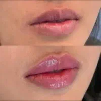 رایگان تزریق بوتاکس و ژل باکادر مجرب