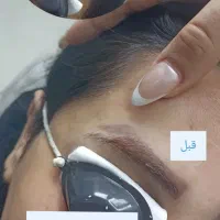 پاککردن تاتو صورت و بدن.تخفیف تا پایان هفته|خدمات آرایشگری و زیبایی|کرمانشاه, |دیوار