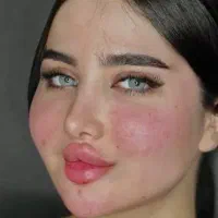 مدل ژل و بوتاکس و انزیم فقط هزینه مواد۴۰۰