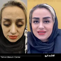 عمل بینی/ کاشت ابرو و مو / بلفارو /تزریق چربی|خدمات آرایشگری و زیبایی|قم, نوبهار|دیوار