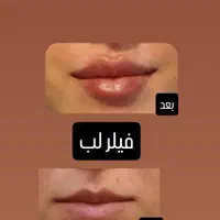 تزریق ژل وبوتاکس با بهترین قیمت در برازجان|خدمات آرایشگری و زیبایی|برازجان, |دیوار