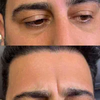 تزریق ژل فیلر مزوژل جوانساز بوتاکس لب روسی مزو مو|خدمات آرایشگری و زیبایی|کرج, گلشهر|دیوار