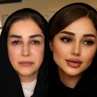 ژل بوتاکس فیلر چشم لب گونه مزوتراپی فشیال نخ لیفت