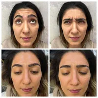 کلینیک ژل لب روسی و بوتاکس و آنزیم فیلر مطب پزشک|خدمات آرایشگری و زیبایی|کرج, گوهردشت|دیوار