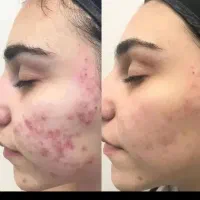 پاکسازی ۲۹۰، فیشیال ،جوانسازی صورت پوست کره ای|خدمات آرایشگری و زیبایی|علیآباد کتول, |دیوار