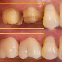 روکش دندان های عقبی ( آسیاب )