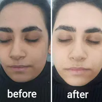 لاغری لیفت مزوتراپی کربن تراپی هایفو فشیال|خدمات آرایشگری و زیبایی|تهران, نظام‌آباد|دیوار