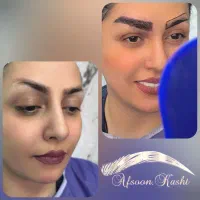 کاشت ابرو و شقیقه با فرم طبیعی