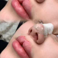 تزریق ژل بوتاکس مدل کاشت ابرو