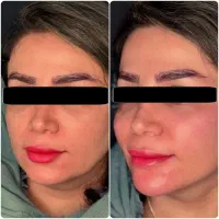 تزریق چربی صورت با ماندگاری ۱۰ ساله - دکتر واحدی|خدمات آرایشگری و زیبایی|قزوین, |دیوار