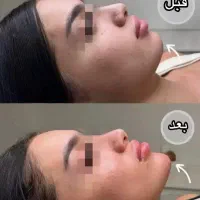 مدل ژل وبوتاکس