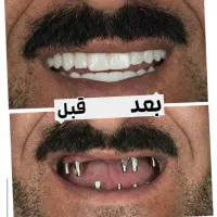 ایمپلنت بدون پیش پرداخت و وام فوری