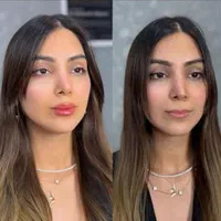 ژل لب بوتاکس زیر بغل فیلر بادی لیفت شقیقه نخ لیفت|خدمات آرایشگری و زیبایی|اصفهان, فیض|دیوار