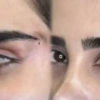 نخ لیفت ابرو جوانساز کلاژن