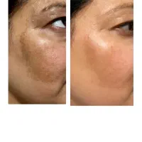 فیشال تخصصی و درمانی صورت و بدن، رفع تیرگی چیتگر|خدمات آرایشگری و زیبایی|تهران, گلستان (شهرک راه آهن)|دیوار