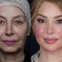 معجزه زیبایی   فیلر و بوتاکس