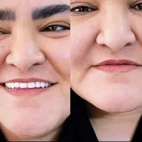 دندانسازی مصنوعی دندان مصنوعی با کیفیت و زیبا|خدمات آرایشگری و زیبایی|تبریز, |دیوار