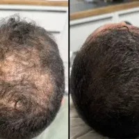 جلوگیری سریع و درمان ریزش مو ، کمک به رویش مجدد