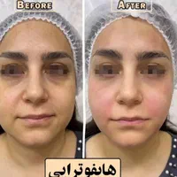 لیزرموزائد سوپرانوتیتانیوم آلما اصلی ۴۹۰تومن