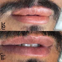 تنها راه درمان و رفع تیرگی لب آقایان