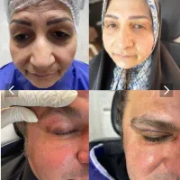 بلفاروپلاستی،ساکشن غبغب،ساکشن بدن