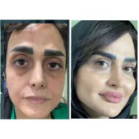 تخفیف ویژه فیلر و بوتاکس