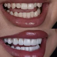 کامپوزیت و روکش خدمات زیبایی و درمانی