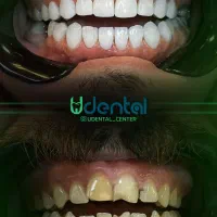 ایمپلنت، لمینت، کامپوزیت اقساط ویژه|خدمات آرایشگری و زیبایی|یاسوج, |دیوار