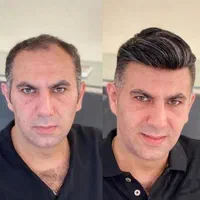 پروتز مو وارداتی ،کاشت hrt|خدمات آرایشگری و زیبایی|اصفهان, گلزار|دیوار