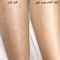 لیزر پیشرفته راهنمایی