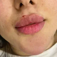 مدل تزریق ژل بوتاکس انزیم اصلاح فرم بینی