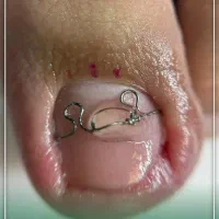 .پدولوژی ودرمان تخصصی عارضه های ناخن وپوست پا|خدمات آرایشگری و زیبایی|مرند, |دیوار