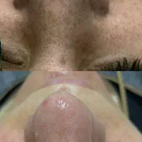 پاکسازی فیشال مراقبت پوستی
