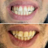 دندانپزشکی دندانسازی روکش|خدمات آرایشگری و زیبایی|نورآباد, |دیوار