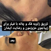 جشنواره تخفیفات یک روزه انجام فیلرزاویه فک وگونه|خدمات آرایشگری و زیبایی|تبریز, |دیوار