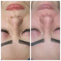 جشنواره فیشال/کربن تراپی/لیزر موهای زائد/ریمو تتو