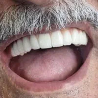 کاشت دندان/جرم گیری دندون/پرکردن دندان/بروساژ