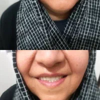 دندان مصنوعی تحویل ۵ساعته(شهر محلات)