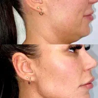 تزریق ژل بوتاکس فیلر بادی توسط پزشک در کلینیک لوکس|خدمات آرایشگری و زیبایی|مشهد, هفت تیر (حافظ)|دیوار