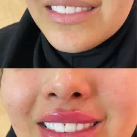 بوتاکس و فیلر و میکرو و خدمات دائمی ارایش رایگان