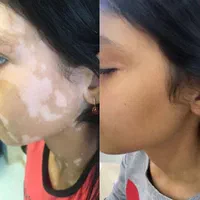 درمان تضمینی پیسی و پسوریازیس|خدمات آرایشگری و زیبایی|مشگین شهر, |دیوار