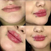 ژل بوتاکس آنریم مزوژل آموزش