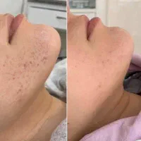 بوتاکس و مزوتراپی