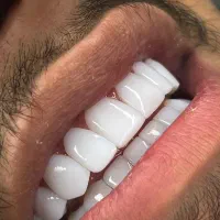 تخفیفات پاییزی کلینیک دیاموند|خدمات آرایشگری و زیبایی|زرندیه, |دیوار