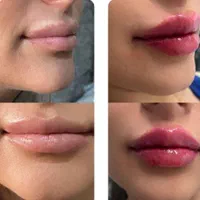 تزریق ژل در کلینیک زیبایی